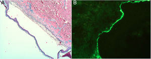 The patient’s skin biopsy. A) A subepidermal blister can be seen, with epidermis of normal appearance and unaltered keratinisation. The blister cavity contains fibrin with nuclear dust and neutrophils. The floor of the blister corresponds to the papillary dermis showing perivascular infiltration of lymphocytes and interstitial infiltration of neutrophils, with practically no eosinophils (haematoxylin-eosin stain ×4). B) Direct immunofluorescence in which a linear band of IgA is observed in the basement membrane (×400 magnification).