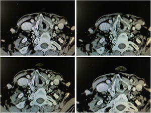 CT images in axial sections with anterior commissure involvement.