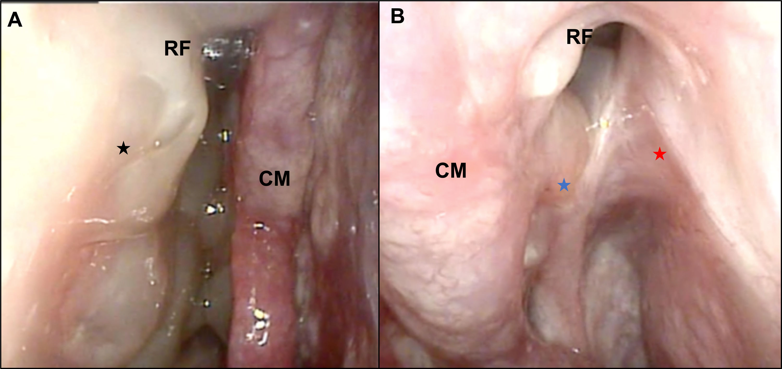 Usefulness of endonasal mucoplasty in the surgical treatment of chronic  rhinosinusitis with nasal polyps. Prospective study | Acta  Otorrinolaringológica Española