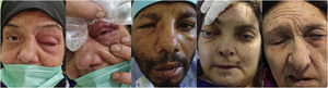 Orbital involvement, (A) Periorbital erythema and swelling, (B) Conjunctival chemosis, (C) Periorbital and lacrimal sac swelling, (D) Proptosis and fixed mydriatic pupill of right eye, (E) Left peripheral facial palsy. Written informed consent was obtained from the participant of the study.