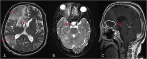Radiological findings of intracranial involvement, (A) T2-weighted magnetic resonance images (MRIs) of brain showing cerebritis and infarction (red arrow). (B) T2-weighted MRI of brain showing cavernous sinus thrombosis (red arrow). (C) Postcontrast T1-weighted MRI of brain showing mucormycosis cerebral abscess in frontal lobe. Proptosis and inflammation extending to the orbital apex effacing the right optic nerve can also be seen.