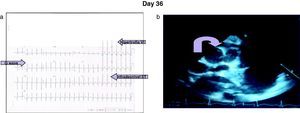 (a) Electrocardiogram showing sinus rhythm, HR 136, P axis +45°, QRS axis +80°, PR 0.11, cQt 0.36, ST depression in V6, Q wave on DI, DII, aVL, and aVR, left ventricular hypertrophy. (b) Echocardiogram reflecting right coronary of 2.4mm, with a saccular aneurism of 7.5mm with intrasaccular thrombus of 0.5cm2.
