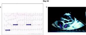 (a) Electrocardiogram showing sinus rhythm, HR 125, a P +30°, QRS axis +60°, PR 0.12, cQt 0.40, Q waves on DII, aVF, and V6. (b) Echocardiogram showing aneurism of the right coronary of 0.1cm2; left anterior descending coronary of 6.8mm; origin of both coronaries of 3mm; EF 61%.