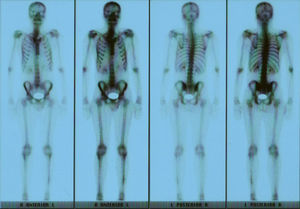 Bone scan with increased uptake of 99Tc may be observed.
