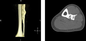 3D sagittal reconstruction, computerized tomography of the left leg: the distal half of the tibial and peroneal diaphysis shows dense cortical hyperostosis with wavy and exhuberant borders and associated periosteal and endosteal thickening, predominantly on the lateral tibia and medial fibula, giving an image of “dripping candlewax”, suggestive of melorheostosis.