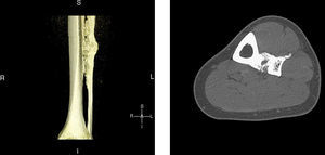 3D sagittal reconstruction, computerized tomography of the left leg: the distal half of the tibial and peroneal diaphysis shows dense cortical hyperostosis with wavy and exhuberant borders and associated periosteal and endosteal thickening, predominantly on the lateral tibia and medial fibula, giving an image of “dripping candlewax”, suggestive of melorheostosis.