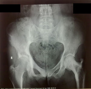 Pelvic X-ray showing a sclerotic pattern of sacroiliac joints.