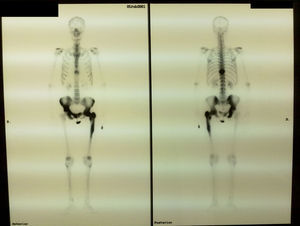 Bone scan showing an increased uptake on D 10, third left proximal interphalangeal joint, pelvis and left femur.