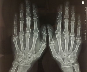 Posteroanterior X-ray of the hands showing affection of the third phalange of the left hand, with the rest of the image being normal.