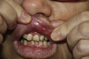 Lesions start through an inflammatory foci in the form of erythematous painful macules.