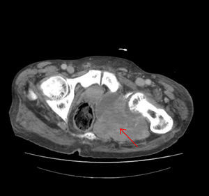 Thoraco-abdominal-pelvic CT showing a great mass with lobulated contour and foci of calcification destroying the ischium and left acetabulum, measuring 12cm×12cm×16cm.