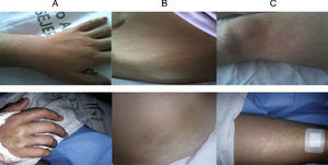 Hypo/hyperpigmented lesions on the right side of the body. (A) Right hand with flexion contracture after carpal tunnel syndrome surgical decompression. (B) Right abdomen. (C) Right thigh. Above, Normal aspect of the contralateral half of the body.