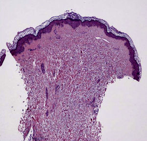 Skin biopsy showing dermal thickening at the expense of collagen fibers extending to subcutaneous tissue.