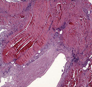 Right carpal flexor retinaculum biopsy showing fibrous aponeurotic tissue and striated muscle in a fibrous collagen stroma accompanied by a mononuclear inflammatory infiltrate.