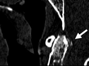 Cervical CT: calcification of the transverse odontoid ligament (sagittal).