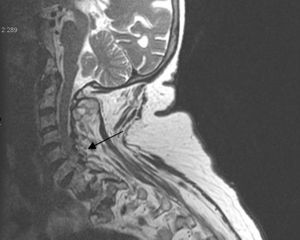 Cervical MR: degenerative changes with ospteophites in the last discs with moderate repercussion on the dural sac with no images of calcification on MR.