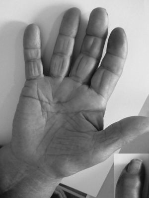 Right hand palm and a detail of the right index finger.