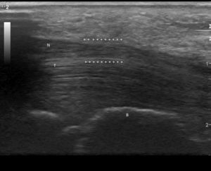 Longitudinal image of the right median nerve. (Image obtained with a General Electrics LOGIC e ultrasound, with a lineal 8–12mHz transducer, using a frequency of 12mHz.) B: large bone; N: median nerve; T: hand flexor tendons; *: compression zone.