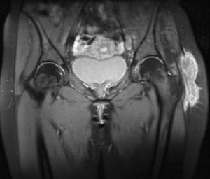 Bilobar collection around the left large trochanter measuring 6cm×2cm×10cm, with heterogeneous content.
