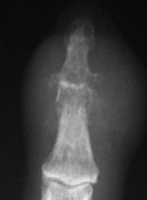 Soft tissue abscess after surgical drainage.