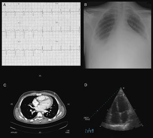 Studies that showed the presence of myopericarditis: sinus tachycardia and negative T waves in V4–V6 ECG (A), global cardiomegaly and bilateral pleural effusion on chest X-ray (B), pleuropericardial effusion and cardiomegaly on thoraco-abdominal CT (C), mild to moderate pericardial effusion on echocardiography (D).