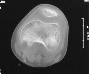 CT of the left knee. There is soft tissue inflammation with an adjacent lytic lesion.