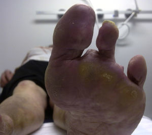 Amputation of several toes of the left foot.