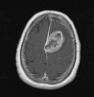Axial cranial T1 magnetic resonance imaging after the administration of intravenous gadolinium that shows the presence of a left frontal mass of 3.5cm×4cm×3cm with heterogeneous peripheral enhancement.