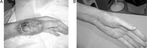 (A) Pyoderma gangrenosum: ulcer with purplish edges and geographic contours located on an erythematous nodule (lesion after 24h of administration of bolus methylprednisolone, with obvious improvement). (B) Favorable progression after 6 weeks of treatment with infliximab.