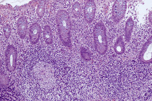 Colon biopsy: an inflammatory infiltrate showing lymphocytes, plasma cells, neutrophils, and eosinophils with occasional granulomas (HE 10×).