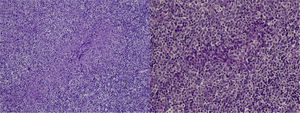 Necrotizing lymphadenitis: zones of necrosis with cellular debris but no neutrophils, surrounded by lymphoid cells and hystiocytes (left). There is a zone of necrosis with numerous hystiocytes and large reactive lymphoid cells (right).