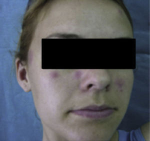 Initial skin manifestations.