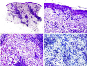 Discoid lupus: periannex lymphoid dermatitis (upper left) with vacuolization of the basal epidermal zone (upper right). Abundant mucin deposits in the reticular dermis (lower left) which are more evident with a colloidal iron stain (lower right).