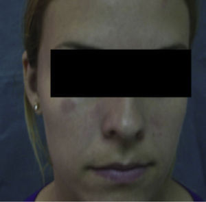 Response to hydroxicloroquine.