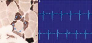 High-frequency repetitive discharges. (A) The potential arises spontaneously in muscle fiber number 1 and epfatic transmission, by contiguity, passes to 2, and then to 3–6 and again at 1. (B) The electromyogram polyphasic potential starts and ends abruptly, which is always the same, and fires rhythmically, and is typically a sound like a machine, “Chaca-Chaca-Chaca”.