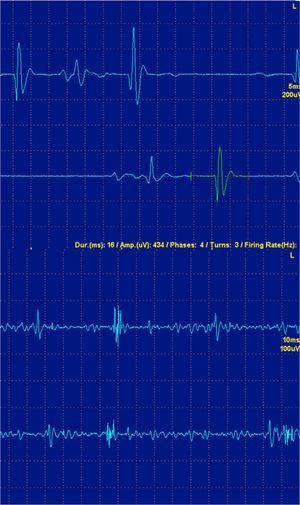 (A) Normal isolated motor unit potentials. (B) Potential of isolated myopathic motor unit. Note that the amplitude and polyphasic potential duration are lower, as well as the polyphasia.