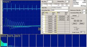 Repetitive stimulation in a patient with congenital myasthenia. Note how the repetition of stimuli at 3Hz, produces a clear decrease in motor potential amplitude. This pattern reflects a neurophysiological disorder of the postsynaptic neuromuscular junction.