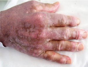 Image of the hands showing Gottron