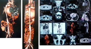 CT angiography. Stenosis at the left subclavian artery, thoracic aorta, abdominal aorta and renal arteries.