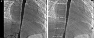 (A) and (B) Cardiac catheterization showing severe stenosis of the thoraco-abdominal aorta. Pressure gradient of 50mmHg. Stenosis below the renal arteries is not severe.