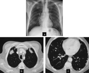 Case 1. Typical and atypical nodules. (a) Preoperative chest radiograph with multiple pulmonary nodules. (b) CT scan of the chest: larger nodules in upper lobes, irregular surface and contour, neoplasia was ruled out by percutaneous biopsy and the diagnosis of rheumatoid nodules was reached. (c) CT scan of the chest: well demarcated, subpleural rounded nodules in lower lobes (parietal pleura, mediastinum, fissures (asterisk)), some isolated and cavitated (arrow). The radiographic appearance is typically of rheumatoid nodules.