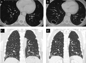 Cases 2 and 3. Evolution of cavitated nodules. (a) and (b) Case 2: cavitated rheumatoid nodules that increase in size. The case was complicated and open pneumothorax produced a cavitated nodule on the pleura (pneumothorax image not shown). (c) and (d) Case 3: rounded subpleural nodules, in a patient with signs of interstitial lung disease. Control computed tomography of nodules show a slight decrease in size and cavitation (arrow).
