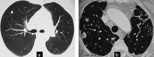 Cases 4 and 5. Different clinical settings: surgical biopsy or control image. (a) Case 5: chest CT: non-specific nodules in a patient without a diagnosis of joint disease and respiratory symptoms. The patient was diagnosed with necrotizing granulomas requiring surgical biopsy. The patient developed rheumatoid arthritis a year later. (b) Case 4: CT scan of the chest: nodules with typical radiological aspect of rheumatoid nodules, rounded, subpleural and multiple in a patient with rheumatoid arthritis associated with interstitial lung disease. Control image.