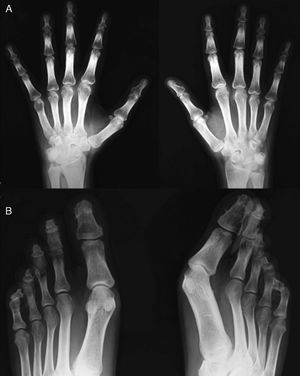 Hand X-ray (A) in which there is a periosteal reaction on the radius. There is distal widening with hypertrophic changes and areas of osteolysis, with a good example on the right fourth finger. Juxtaarticular demineralization. Feet X-ray (B) observing marked destruction of the distal phalanges, some with flattened morphology and distal hypertrophy with bone proliferation. There is marked deformity of the fingers.