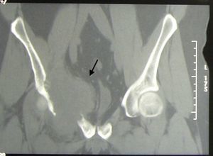Pelvis CT: lysis of the medial or superior portion of the acetabulum extended to the iliac and superior pubic ramus, associated with a large soft tissue mass measuring 12mm×74mm×73mm (arrow), infiltrating muscle.