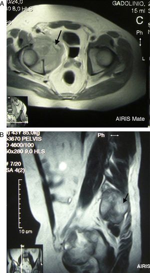(A and B) Axial and coronal MR of the hips RM in T2 sequence with contrast. A voluminous mass in the right hemipelvis is shown, affecting the anterior half of the cotillum, the iliac and pubic ramus, displacing the urinary bladder and adjacent structures leftward, with an isointense signal with bone and increased intensity with contrast, except in areas of intense necrosis.