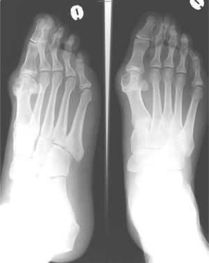 Anteroposterior and oblique X-ray of left foot: well demarcated marginal erosions are observed on the first metatarsal head, with increased adjacent soft tissue. The joint space and the density of the rest of the subchondral bone is preserved.