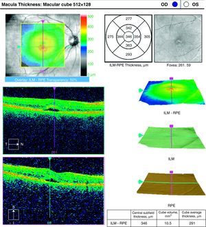 Optical coherence tomography of the right eye of the patient showing discrete thickening of the fovea, with a hyporeflective space in the outer layers of the retina (arrows).