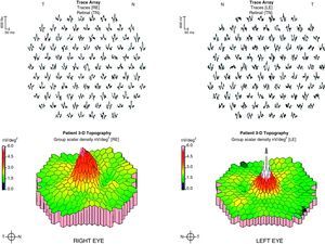 Central multifocal electroretinogram with 100 hexagons. We observe a moderate decrease in the rpower density of the foveal region of the right eye (no white areas).
