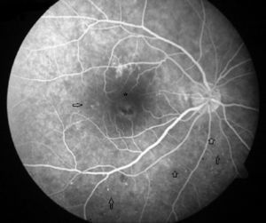 Angiography of the right eye. Microaneurysms are seen in inferior temporal region and a small temporal macula area (arrows). Hypo-and hyperfluorescent images of the fovea (asterisk) are not modified during the angiogram.